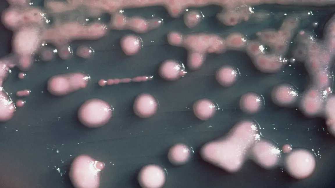 تصویر مرتبط با خبر: A woman got a UTI. Two years later, the bacteria had evolved, invaded her brain.